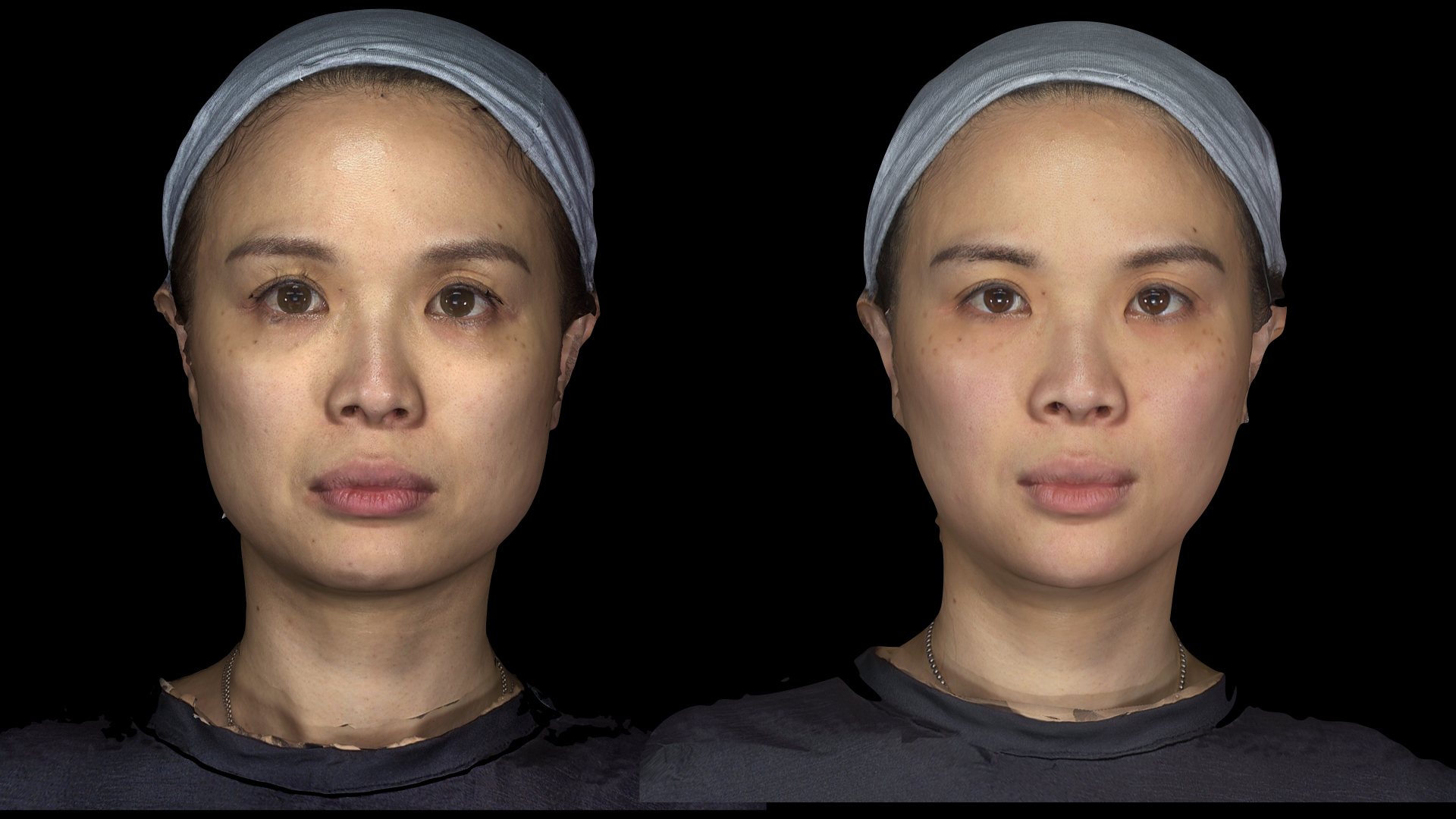 永和皮膚科推薦：林上立醫師 少女針洢蓮絲Ellanse漸進式膠原蛋白增生，不讓歲月在臉上留下痕跡