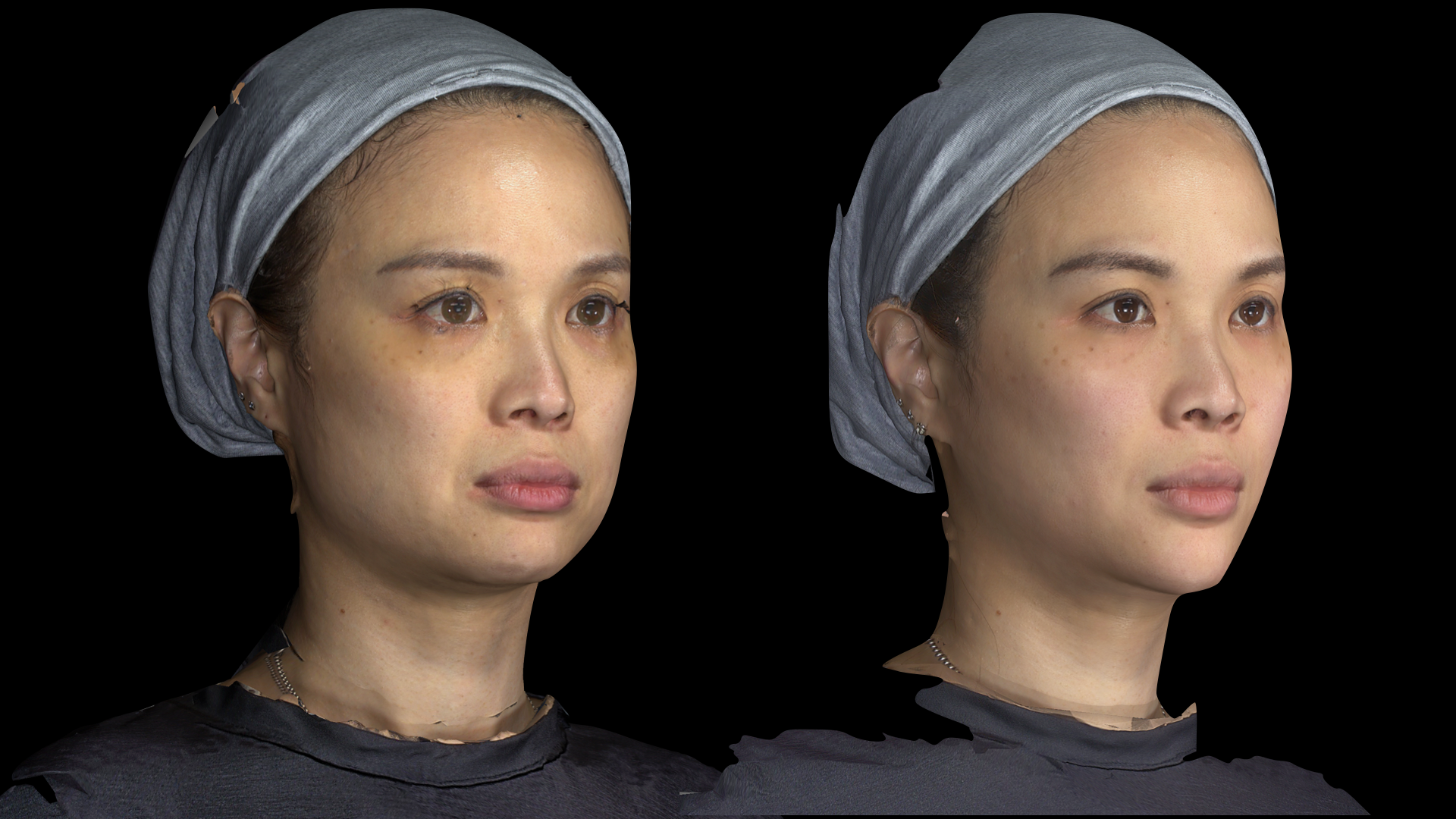 永和皮膚科推薦：林上立醫師 少女針洢蓮絲Ellanse漸進式膠原蛋白增生，不讓歲月在臉上留下痕跡